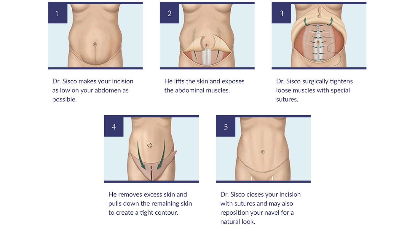 How to Handle Post-Tummy Tuck Pains - Vera Clinic